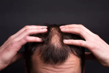 calvicie e perda de cabelo, saiba qual a diferenca