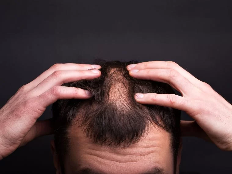 calvicie e perda de cabelo, saiba qual a diferenca
